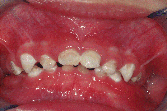 نمایی از پوسیدگی های دندانی در کودکی که بدون نظارت والدین مسواک زده است.