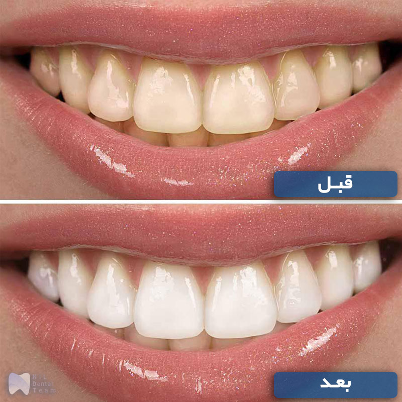 بلیچینگ (bleaching) یا سفید کردن دندان - تیم دندانپزشکی نیل | Nil Dental Team