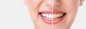 بلیچینگ (bleaching) یا سفید کردن دندان - تیم دندانپزشکی نیل | Nil Dental Team