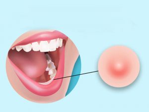 موکوسل چیست؟ | تیم دندانپزکشی نیل - Nil Dental Team
