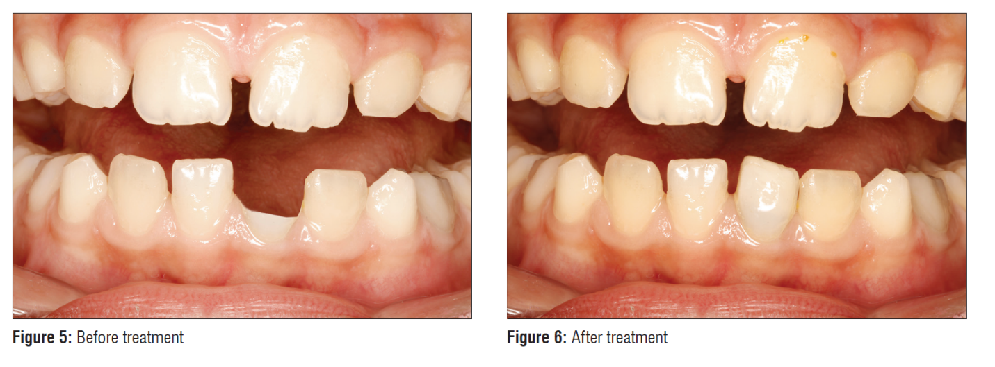 تراما چیست؟ | تیم دندانپزشکی نیل - Nil Dental Team