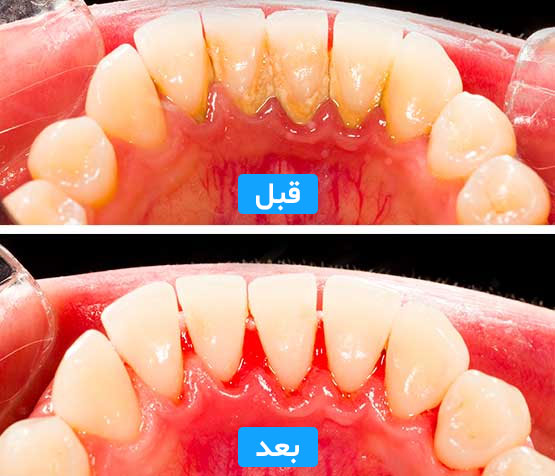 جرمگیری | تیم دندانپزشکی نیل - Nil Dental Team