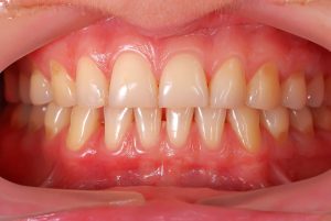 سفید کردن دندانها، جرمگیری یا بلیچینگ | تیم دندانپزشکی نیل - Nil Dental Team