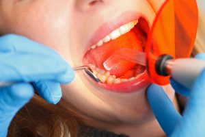 عمر ترمیم دندان | تیم دندانپزشکی نیل - Nil Dental Team