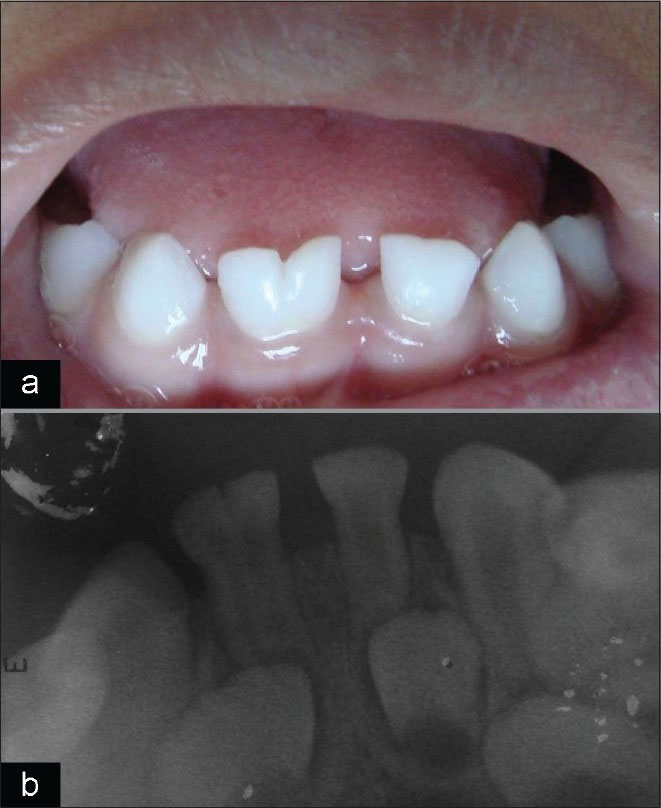 فیوژن یا جوش خوردن دندان‌ها | تیم دندانپزشکی نیل - Nil Dental Team