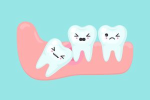 دندان نهفته چیست؟ | تیم دندانپزشکی نیل - Nil Dental Team