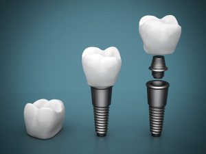 همه چیز درباره ی روکش ایمپلنت | تیم دندانپزشکی نیل - Nil Dental Team