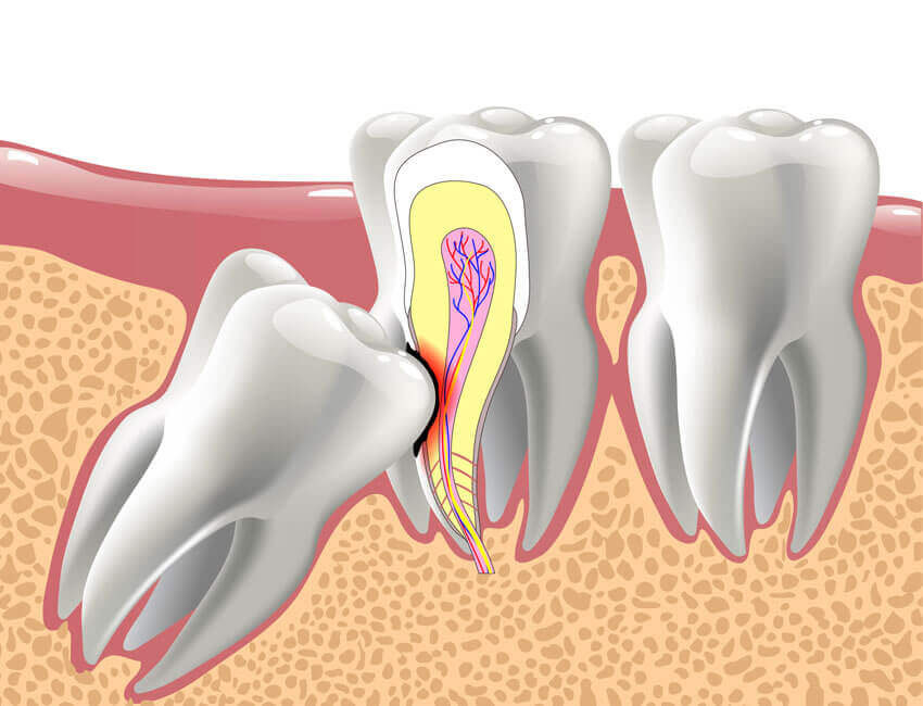 شایع ترین دندانی که نهفته می شود | تیم دندانپزشکی نیل - Nil Dental Team