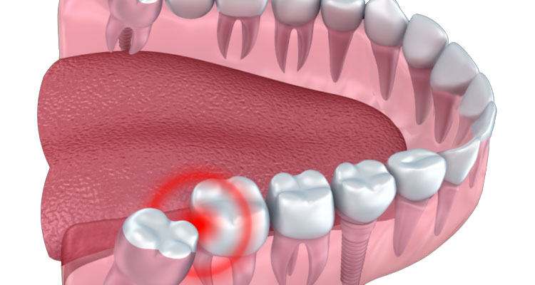 عوارض حضور دندان عقل نهفته | تیم دندانپزشکی نیل - Nil Dental Team