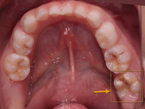 دندان کرسی دائمی اول کودکان | تیم دندانپزشکی نیل - Nil Dental Team