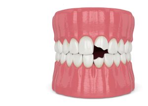 تراما Trauma | تیم دندانپزشکی نیل - Nil Dental Team