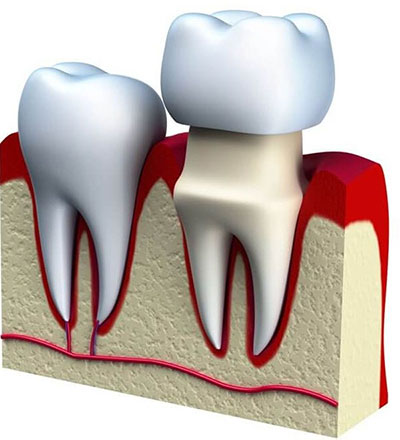 نحوه افزایش طول تاج | تیم دندانپزشکی نیل - Nil Dental Team