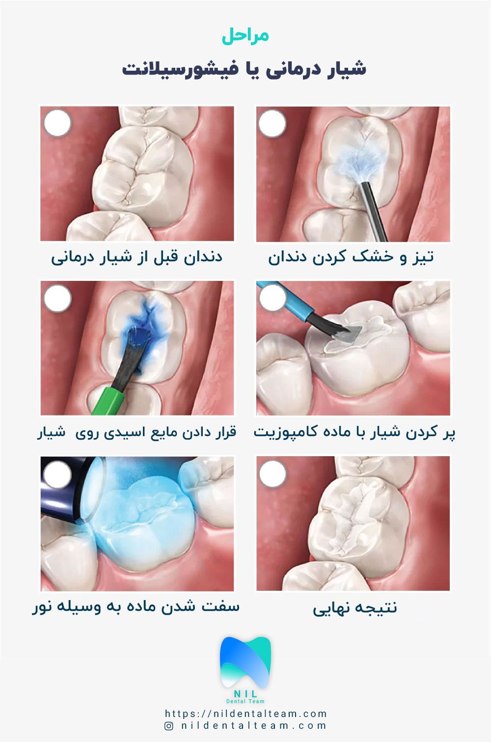 مراحل فیشور سیلانت | تیم دندانپزشکی نیل - Nil Dental Team