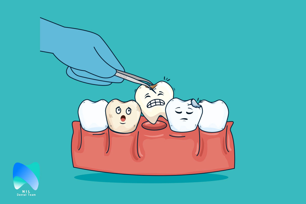 کشیدن دندان کودکان | تیم دندانپزشکی نیل - Nil Dental Team