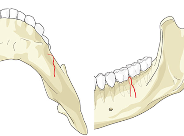 شکستگی فک کودکان | تیم دندانپزشکی نیل - Nil Dental Team