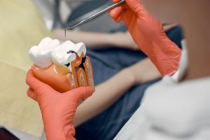 درمان غیرمستقیم عصب دندان | تیم دندانپزشکی نیل - Nil Dental Team