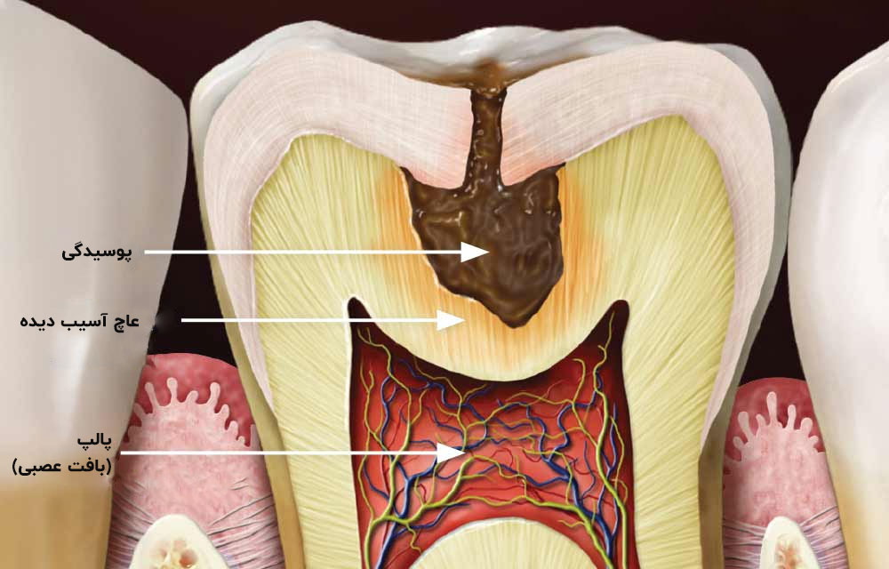 درمان پوسیدگی های عمیق | تیم دندانپزشکی نیل - Nil Dental Team