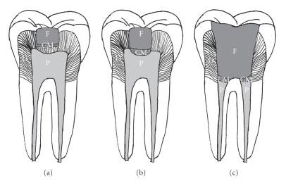 درمان غیرمستقیم عصب دندان | تیم دندانپزشکی نیل - Nil Dental Team