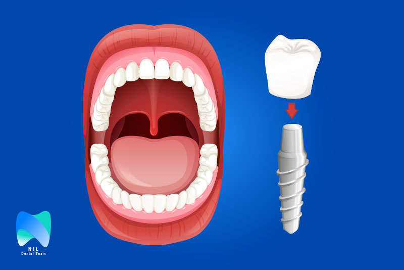 ایمپلنت چیست؟ | تیم دندانپزشکی نیل - Nil Dental Team