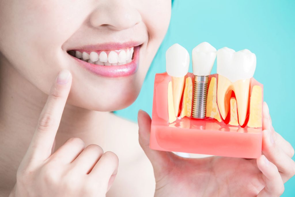 آیا ایمپلنت برای افراد سیگاری انجام می‌شود؟ | تیم دندانپزشکی نیل - Nil Dental Team