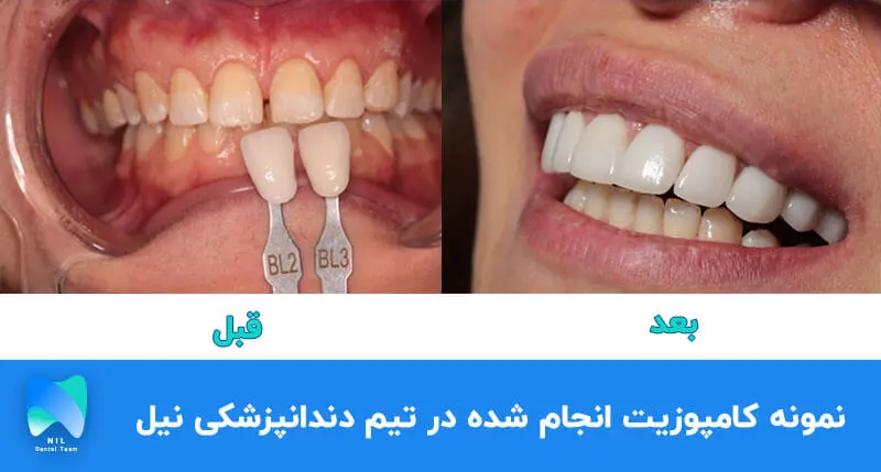 نمونه کامپوزیت زیبایی دندان انجام شده در تیم دندانپزشکی نیل | تیم دندانپزشکی نیل - Nil Dental Team