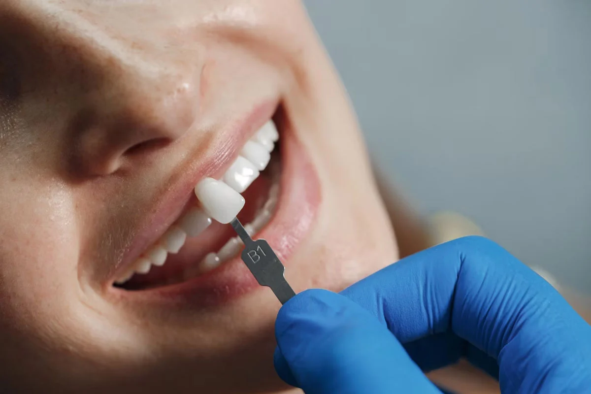 کامپوزیت دندان | تیم دندانپزشکی نیل - Nil Dental Team