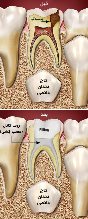 ریشه غیر عفونی عصب کشی شده دندان شیری | تیم دندانپزشکی نیل - Nil Dental Team