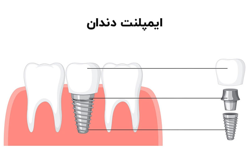 ایمپلنت شامل یک پیچ است که وارد استخوان می شود | تیم دندانپزشکی نیل - Nil Dental Team