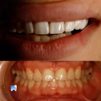 نمونه درمان زیبایی انجام شده در تیم دندانپزشکی نیل
