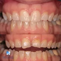 نمونه درمان زیبایی انجام شده در تیم دندانپزشکی نیل