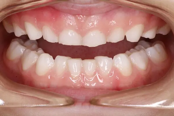 نتایج دندان قروچه کودکان - تیم دندانپزشکی نیل